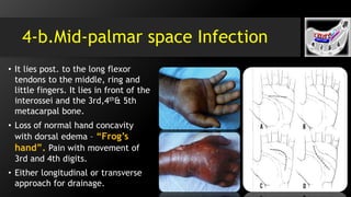 4-b.Mid-palmar space Infection
• It lies post. to the long flexor
tendons to the middle, ring and
little fingers. It lies in front of the
interossei and the 3rd,4th& 5th
metacarpal bone.
• Loss of normal hand concavity
with dorsal edema – “Frog’s
hand”. Pain with movement of
3rd and 4th digits.
• Either longitudinal or transverse
approach for drainage.
 