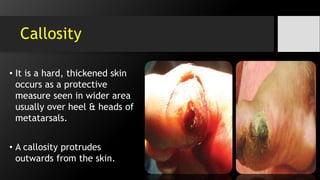 Callosity
• It is a hard, thickened skin
occurs as a protective
measure seen in wider area
usually over heel & heads of
metatarsals.
• A callosity protrudes
outwards from the skin.
 