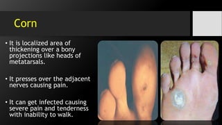 Corn
• It is localized area of
thickening over a bony
projections like heads of
metatarsals.
• It presses over the adjacent
nerves causing pain.
• It can get infected causing
severe pain and tenderness
with inability to walk.
 