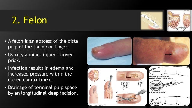 Nail Fungal Infections - familydoctor.org