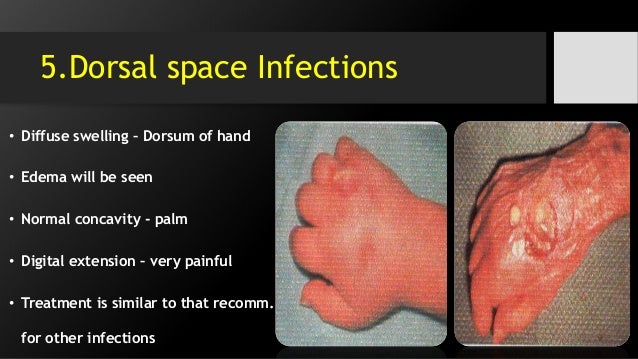 Soft tissue edema over dorsum foot