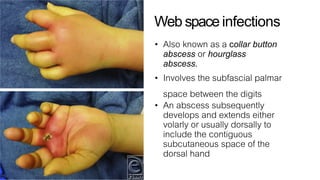 Hand infections | PDF