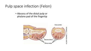 Finger Rip Pulp Hand Infections3.pptx