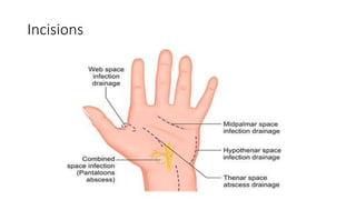 Brunner Incision Han Hand Infections3.pptx