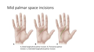 Brunner Incision Han Hand Infections3.pptx