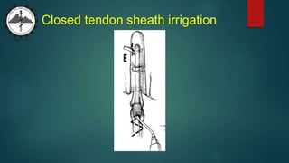 Closed tendon sheath irrigation
 