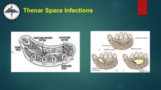Thenar Space Infections
 