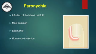 Paronychia
 Infection of the lateral nail fold
 Most common
 Eponychia
 Run-around infection
 