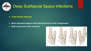 Deep Subfascial Space Infections
 Collar-Button Abscess
 Most important aspect-Treat both dorsal and volar components
 Both dorsal and volar incisions
 