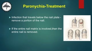 Paronychia-Treatment
 Infection that travels below the nail plate -
remove a portion of the nail.
 If the entire nail matrix is involved,then the
entire nail is removed.
 