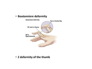 • Boutonniere deformity
• Z deformity of the thumb
 