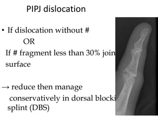PIPJ dislocation
• If dislocation without #
OR
If # fragment less than 30% joint
surface
→ reduce then manage
conservatively in dorsal blocking
splint (DBS)
 