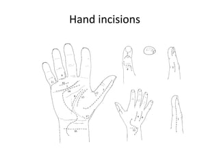 Racket Incision Hand Hand Injuries Overview- Surgery | PPT