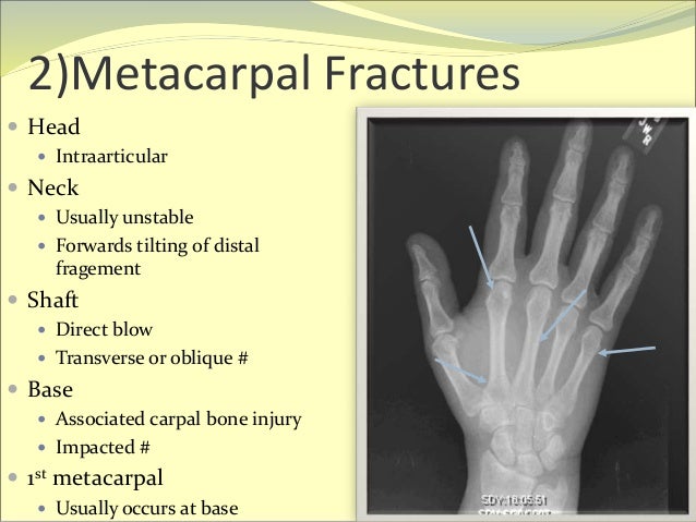 metacarpal fracture symptoms