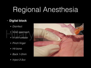 Regional Anesthesia
• Digital block
• Disinfect
• Volar approach
• In skin crease
• Pinch ﬁnger
• Hit bone
• Back 1-2mm
• Inject 2-3cc
Skin Lacerations
After hemostasis is achieved and appropriate local
or regional anesthesia provided, all skin lacerations
Figure 4. The Volar Single-Injection Method
For Digital Nerve Anesthesia
Note the injection site is at the volar MCP skin crease and the clinician
is lightly pinching the digit. A 25-gauge needle should be advanced
until it hits bone, backed up 1-2 mm, and 2-3 cc of anesthetic in-
jected. Used with permission of Aaron Andrade, MD.
Hilary Lee 2015
 