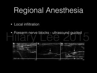 Regional Anesthesia
• Local inﬁltration
• Forearm nerve blocks - ultrasound guided
Emergency Medicine Practice © 2011 8 ebmedicine.net • June 2011
usually heal by secondary intention if less than 1 cm
in diameter. If there is a small amount of exposed
bone, the bone can be trimmed back in the ED with
a rongeur until it is underneath the surrounding soft
tissue and allowed to heal by secondary intention.
Follow-up with a hand surgeon is advised. Imme-
diate consultation of a hand surgeon is required in
cases of wounds larger than 1 cm in diameter, per-
sistently exposed bone, or amputation of the volar
pad.33
Additionally, surgeons subclassify ﬁngertip
injuries into zones I, II, and III. (See Figure 7.) Zone
I injuries are managed conservatively as described
above. Zone II injuries may require rongeuring of ex-
posed bone. Zone III injuries generally require distal
phalanx amputation and warrant follow-up with a
hand specialist.34
Fractures
Perhaps the most important job of an emergency
clinician in hand fractures is proper reduction and
severe crush injuries with large losses of soft tissue.
Intra-articular fractures require thorough examination
to rule out associated tendon avulsions and should
always be evaluated by a hand specialist.23
Subungual Hematoma/Nail Bed Lacerations
In crush injuries of the ﬁnger, nail bed lacerations
causing subungual hematomas are common. They
are characterized by throbbing pain and purple
discoloration under the nail. Two management
strategies are commonly used in the ED: removal
of the nail, with direct repair of nail bed laceration;
and nail trephination with a heated paperclip, a
cautery device, or a twirled 18-g needle. A review of
the classic literature yields a long-standing debate
about which management strategy is superior. The
commonly taught “consensus” is that nail bed repair
should be considered for subungual hematomas
covering greater than 25% to 50% of the nail bed.25-30
However, a 1999 prospective study in children dem-
Figure 5. Ultrasound Visualization Of Nerves And Arteries In The Forearm
Ulnar, medial, and radial nerves are shown by the arrow across the bottom of the images. Arrowheads show arteries, A (ulnar), B (medial), and C
(radial).
Liebmann O, Price D, Mills C et al. Ann Emerg Med. 2006;48(5)558-562. Used with permission of Mosby, Inc.
A B C
Hilary Lee 2015
 