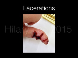 Lacerations
Hilary Lee 2015
 