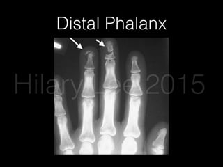 Distal Phalanx
be splinted and
fractures and th
ceive immediat
Figure 6. Radiograph Demonstrating
Phalanx Fractures
Left arrow notes a tuft fracture of digit IV. Right arrow notes a shaft
Figure 7. Zon
Zone I
Zone I
Hilary Lee 2015
 