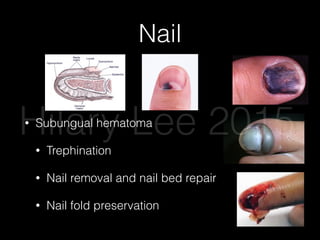 Nail
• Subungual hematoma
• Trephination
• Nail removal and nail bed repair
• Nail fold preservation
Hilary Lee 2015
 