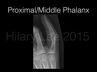 Proximal/Middle Phalanx
Hilary Lee 2015
 