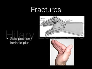 Fractures
• Safe position /
intrinsic plus
rates of anxiety, borderline per
antisocial personality disorder
with boxer’s fractures should
evaluation psychiatric questio
vention strategies.
Thumb Metacarpal Fractures:
Fractures
Fractures of the ﬁrst metacarp
than those of the remaining m
be subdivided into extra-articu
fractures. Extra-articular fractu
conservative management prin
carpal fractures, namely, close
angulation goal of less than 20
thumb spica splinting for 4 we
are unstable and require prom
hand surgeon.43
Intra-articular fractures of
involve the CMC joint and gen
an axial injury to a partially ﬂe
Bennett fracture is an intra-art
dislocation; a Rolando fracture
intra-articular fracture.44
(See
debate exists regarding the spe
correction each fracture requir
ture supports that emergency
consist of closed reduction (Be
surgical clinic follow-up. Unstable fractures of the
II and III metacarpals generally require immediate
consultation by a hand surgeon for surgical correc-
tion. Unstable fractures in the IV and/or V meta-
carpals, also known as a boxer’s fracture, can be
reduced in the ED after adequate anesthesia. In the
author’s experience, a forearm ulnar nerve block in
conjunction with a hematoma block using 1% lido-
caine without epinephrine provides excellent results.
Reduction is achieved by traction decompression
followed by the “90-90 method.” (See Figure 10.)
The MCP, PIP, and DIP joints are ﬂexed at 90° and
volar-ward pressure is applied to the dorsum of the
metacarpal shaft. An ulnar gutter splint should be
applied with prompt clinic follow-up within 1 week.
Much controversy exists in the literature regard-
ing the goal of boxer’s fracture reduction. Classic
literature supports acceptable angulation between
20° and 70°.37
More-recent studies are incongruent.
A 1999 cadaveric study concluded that angulation
greater than 30° resulted in measurable functional
impairment.38
Two more recent prospective stud-
ies, however, found good outcomes with 1 week of
soft wrap followed by immediate buddy-wrapping
Figure 8. The “Intrinsic Plus” Splinting
Position
Used with permission of Aaron Andrade, MD.
Figure 9. “Buddy-Taping”
Used with permission of Aaron Andrade,
Hilary Lee 2015
 