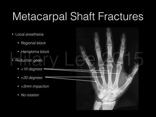 Metacarpal Shaft Fractures
• Local anesthesia
• Regional block
• Hematoma block
• Reduction goals
• <10 degrees
• <20 degrees
• <3mm impaction
• No rotation
Hilary Lee 2015
 
