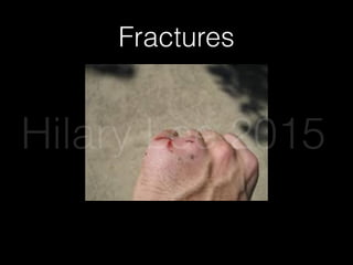 Fractures
Hilary Lee 2015
 