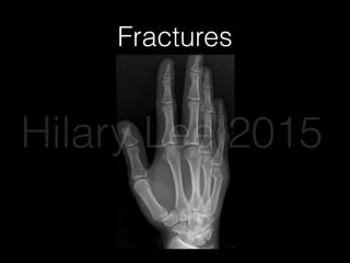 Fractures
Hilary Lee 2015
 