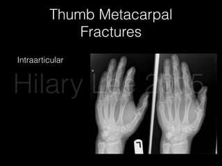 Thumb Metacarpal
Fractures
Intraarticular
Hilary Lee 2015
 