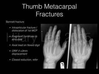 Thumb Metacarpal
Fractures
Bennett fracture
• Intraarticular fracture /
dislocation of 1st MCP
• Fragment continues to
articulate
• Axial load on ﬂexed digit
• ORIF if >3mm
displacement
• Closed reduction, refer
Hilary Lee 2015
 