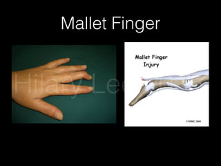 Mallet Finger
Hilary Lee 2015
 