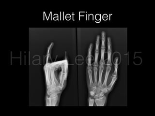Mallet Finger
Hilary Lee 2015
 