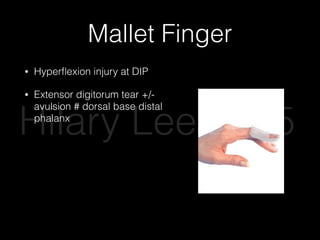 Mallet Finger
• Hyperﬂexion injury at DIP
• Extensor digitorum tear +/-
avulsion # dorsal base distal
phalanx
• Splint DIP in hyperextension for
6 weeks, refer
• Do not splint DIP
• If open or >30% articular
surface avulsed, ORIF
Hilary Lee 2015
 