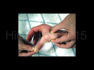 d place
CP
in 30°
greater
umb is
mplete
ner
omes
Figure 15. Valgus Stress Testing Of The First
MCP Joint
Ulnar deviation by greater than 35° or 15° more than the unaffected
side is diagnostic of a complete UCL rupture.
From Rhee S, Cobiella C. Trauma. 2007;9:163-170, copyright © 2007ateral bands
Hilary Lee 2015
 