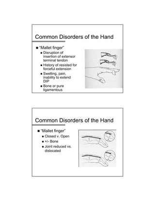 Common Disorders of the Hand
 “Mallet finger”
 Disruption of
insertion of extensor
terminal tendon
 History of resisted for
forceful extension
 Swelling, pain,
inability to extend
DIP
 Bone or pure
ligamentous
Common Disorders of the Hand
 “Mallet finger”
 Closed v. Open
 +/- Bone
 Joint reduced vs.
dislocated
 