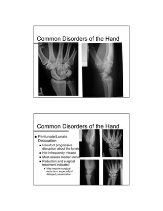 Common Disorders of the Hand
Common Disorders of the Hand
 Perilunate/Lunate
Dislocation
 Result of progressive
disruption about the lunate
 Not infrequently missed
 Must assess median nerve
 Reduction and surgical
treatment indicated
 May require surgical
reduction, especially if
delayed presentation
 
