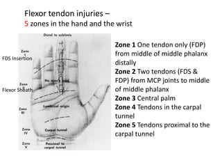 Flexor tendon injuries –
5 zones in the hand and the wrist
Zone 1 One tendon only (FDP)
from middle of middle phalanx
distally
Zone 2 Two tendons (FDS &
FDP) from MCP joints to middle
of middle phalanx
Zone 3 Central palm
Zone 4 Tendons in the carpal
tunnel
Zone 5 Tendons proximal to the
carpal tunnel
FDS Insertion
Flexor Sheath
 