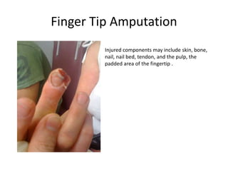Finger Tip Amputation
Injured components may include skin, bone,
nail, nail bed, tendon, and the pulp, the
padded area of the fingertip .
 