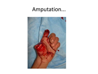 Amputation...
 