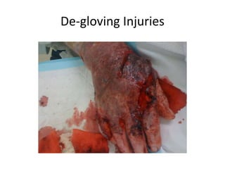 De-gloving Injuries
 