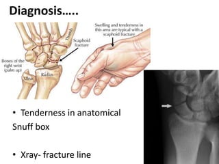 Diagnosis…..
• Tenderness in anatomical
Snuff box
• Xray- fracture line
 