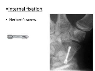 •Internal fixation
• Herbert’s screw
 