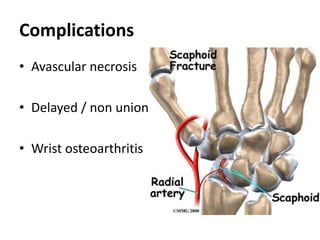 Complications
• Avascular necrosis
• Delayed / non union
• Wrist osteoarthritis
 
