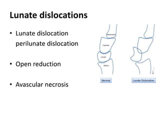 Lunate dislocations
• Lunate dislocation
perilunate dislocation
• Open reduction
• Avascular necrosis
 