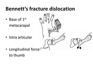 Bennett’s fracture dislocation
• Base of 1st
metacarapal
• Intra articular
• Longitudinal force
to thumb
 