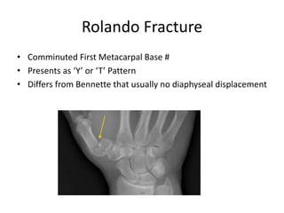 Rolando Fracture
• Comminuted First Metacarpal Base #
• Presents as ‘Y’ or ‘T’ Pattern
• Differs from Bennette that usually no diaphyseal displacement
 