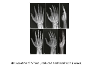 #dislocation of 5th mc , reduced and fixed with k wires
 