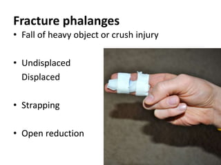 Fracture phalanges
• Fall of heavy object or crush injury
• Undisplaced
Displaced
• Strapping
• Open reduction
 