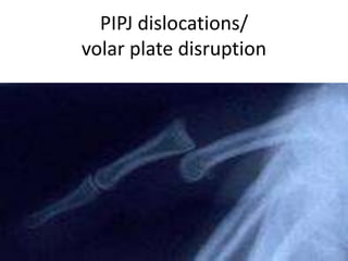 PIPJ dislocations/
volar plate disruption
 