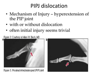 PIPJ dislocation
• Mechanism of Injury – hyperextension of
the PIP joint
• with or without dislocation
• often initial injury seems trivial
 